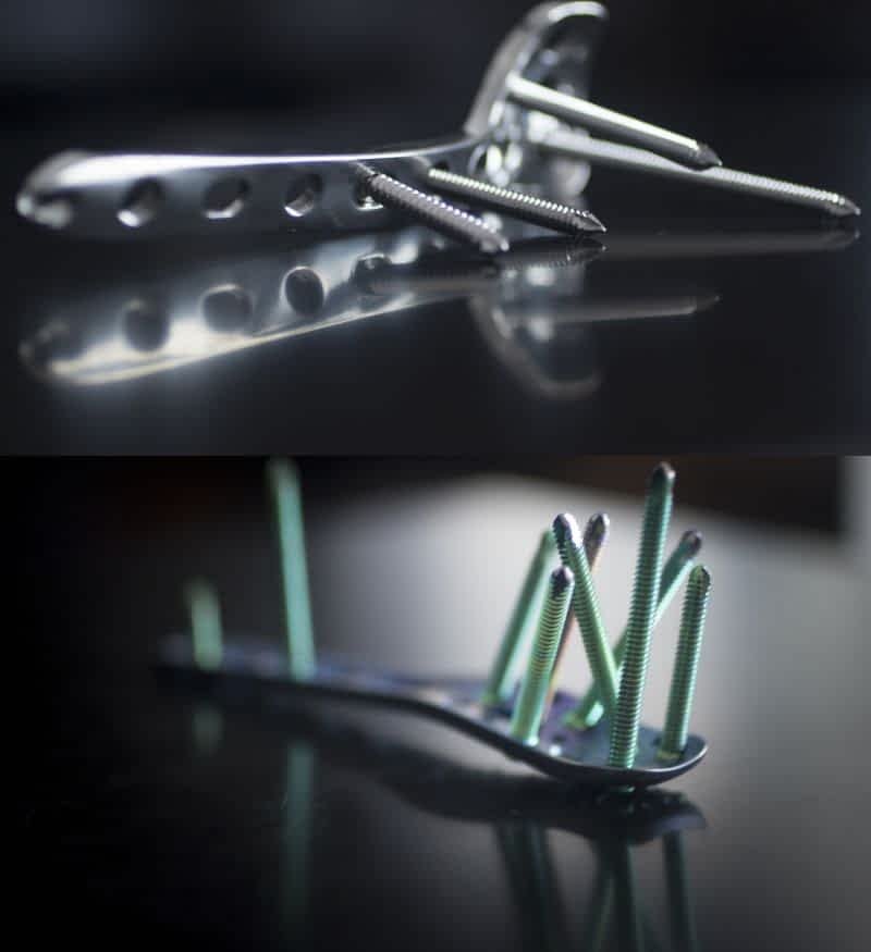 Understanding the Medifit Proximal Tibia Plate: A Crucial Tool in Orthopedic Fixation 5 Orthopedic implants